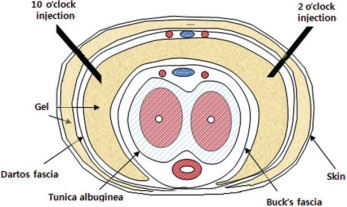 Penis enlargement fat injection diagram