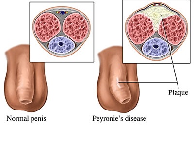 Peyronies-disease-example diagram