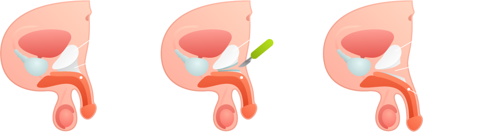 penis-enlargement-surgery-suspensory-ligament diagram