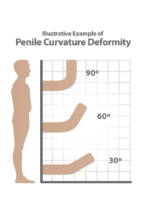 peyronies-disease-diagnosis-by-curvature-angle diagram